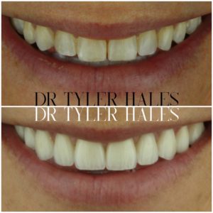 dr-tyler-hales-veneer-consult (1)