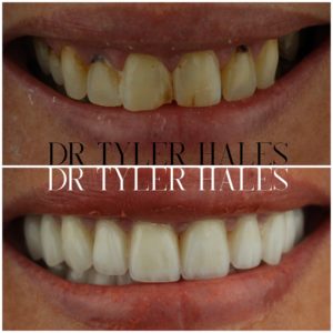 dr-tyler-hales-veneer-consult (10)