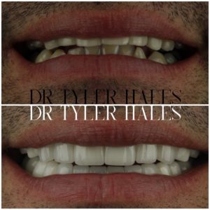 dr-tyler-hales-veneer-consult (11)