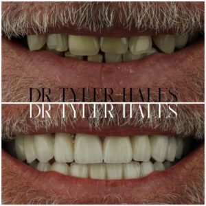 dr-tyler-hales-veneer-consult (12)