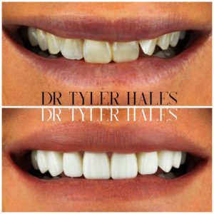 dr-tyler-hales-veneer-consult (13)