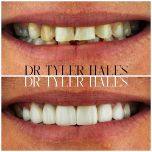 dr-tyler-hales-veneer-consult (15)