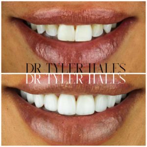 dr-tyler-hales-veneer-consult (16)