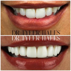 dr-tyler-hales-veneer-consult (17)