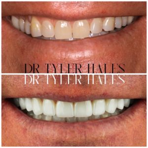 dr-tyler-hales-veneer-consult (18)