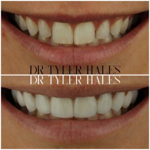 dr-tyler-hales-veneer-consult (19)