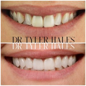 dr-tyler-hales-veneer-consult (2)