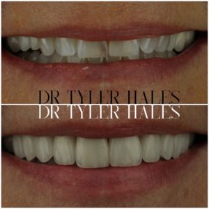 dr-tyler-hales-veneer-consult (20)