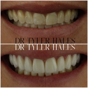 dr-tyler-hales-veneer-consult (21)