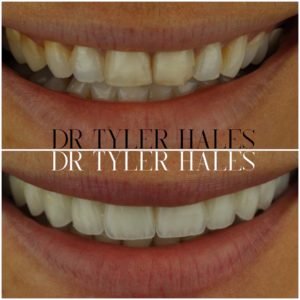 dr-tyler-hales-veneer-consult (22)