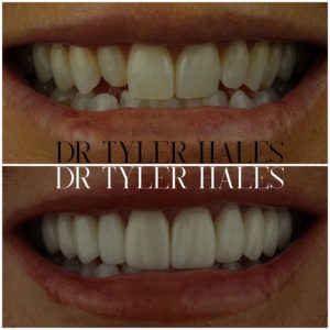 dr-tyler-hales-veneer-consult (23)