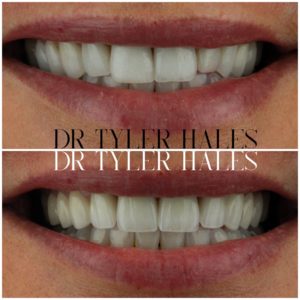 dr-tyler-hales-veneer-consult (24)