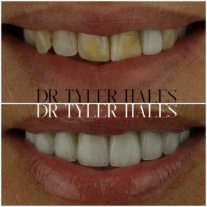 dr-tyler-hales-veneer-consult (25)