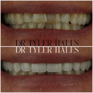 dr-tyler-hales-veneer-consult (26)