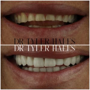 dr-tyler-hales-veneer-consult (27)