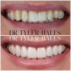 dr-tyler-hales-veneer-consult (3)