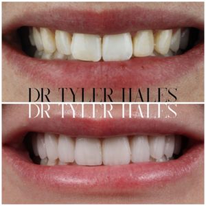 dr-tyler-hales-veneer-consult (4)