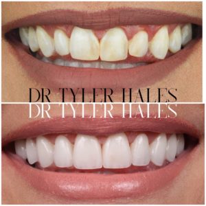 dr-tyler-hales-veneer-consult (5)