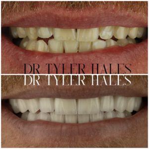 dr-tyler-hales-veneer-consult (6)