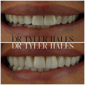 dr-tyler-hales-veneer-consult (8)