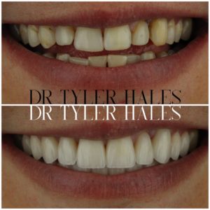 dr-tyler-hales-veneer-consult (9)