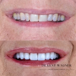 kent-wagner-gallary-I-veneer-consult