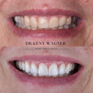 kent-wagner-gallary-e-veneer-consult