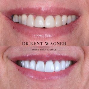 kent-wagner-gallary-g-veneer-consult